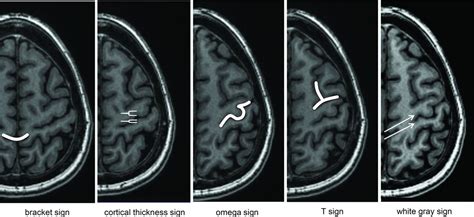 Image result for Sulcus Sign Grading