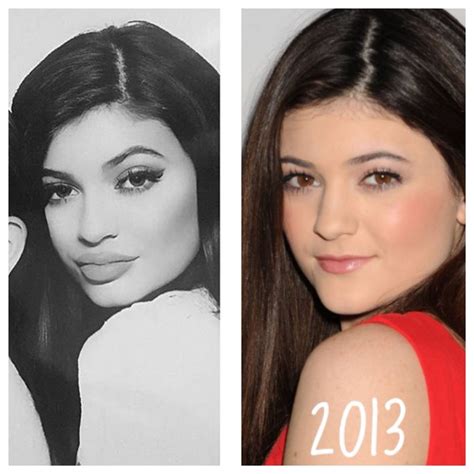 Kylie Jenner before and after plastic surgery | Kylie jenner plastic surgery, Cosmetic surgery ...