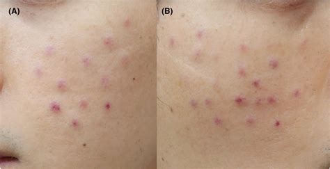 Skin necrosis after intradermal injection of lyophilized exosome: A case report and a review of ...