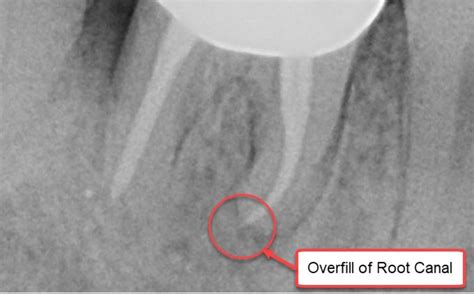What Causes Root Canal Infections and Failure? - Integrative Dentistry, San Diego Holistic Dentist