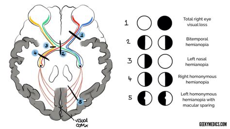 Image result for Visual Pathway Defects