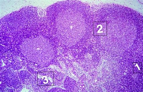 White Blood Cell disorders Flashcards | Quizlet