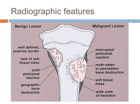 Benign bone tumors | PPTX