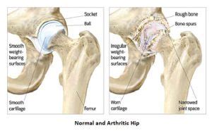 Hip Arthritis - DR. SARANG DESHPANDE