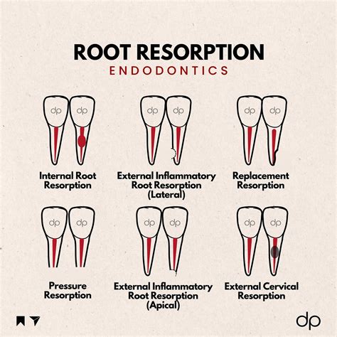 External Resorption Vs Internal Resorption