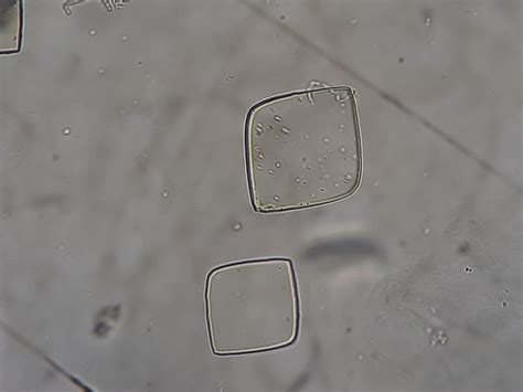 Urate Crystals: Introduction, Identification Features, and Clinical