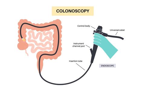 A Colonoscopy Procedure 的图像结果