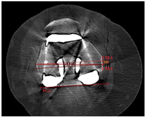 Robotic-Assisted Total Knee Arthroplasty Utilizing NAVIO, CORI ...