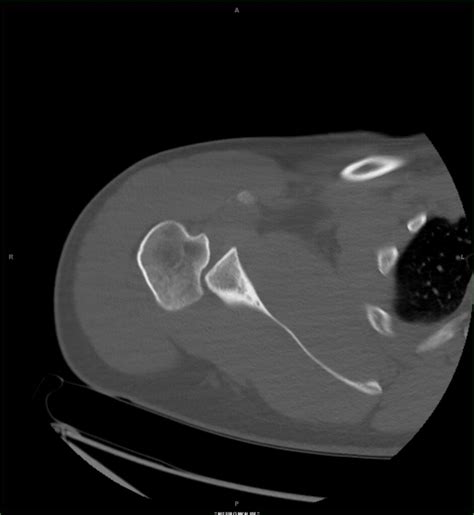 Image result for Posterior Shoulder Dislocation Sulcus Sign