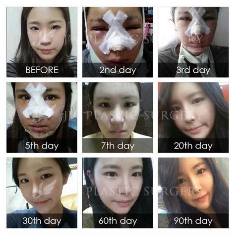 List 105+ Pictures Rhinoplasty Recovery Photos Day By Day Updated