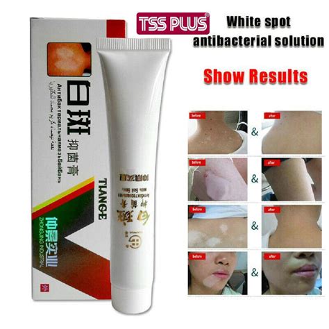 Buy 30g Chinese Medical White Spot Disease Cream Pigment Melanin ...