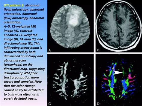Image result for Diffuse Tensor Imaging