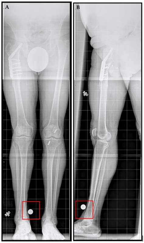 Motorized Intramedullary Nail Lengthening in the Older Population
