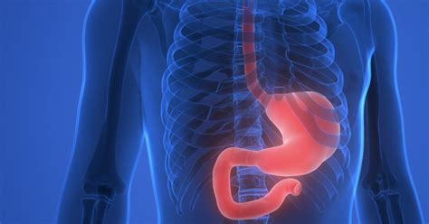 Image result for Linx Procedure Recovery