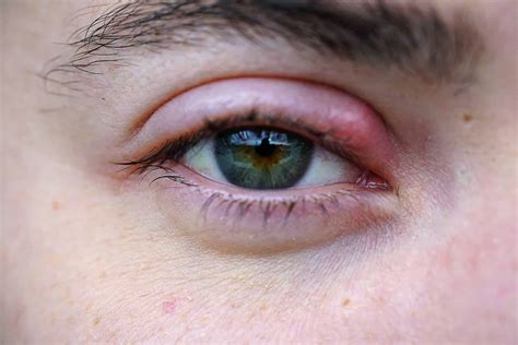 Stye Treatment Over The Counter