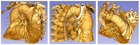 Aorta Ascending Aneurysm Analysis Using CFD Models towards Possible ...