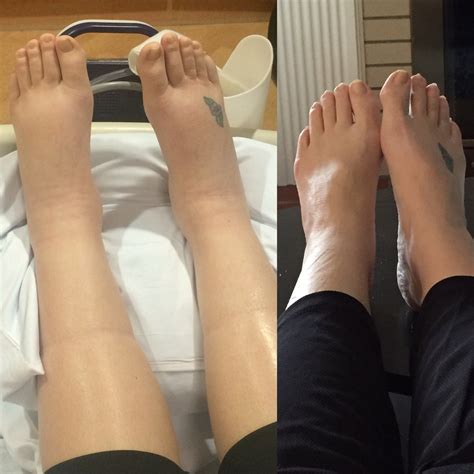 Postpartum Feet Swelling