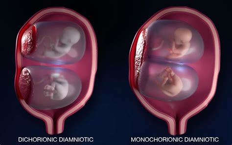 Polyhydramnios In Dichorionic Diamniotic Twins - Causes, Symptoms, And ...