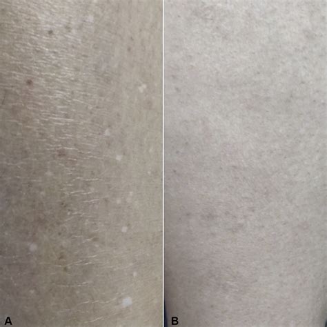 Idiopathic Guttate Hypomelanosis