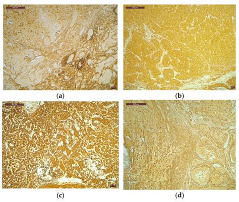 Chronic Diarrhea Caused by Vasoactive Intestinal Peptide-Secreting Tumor