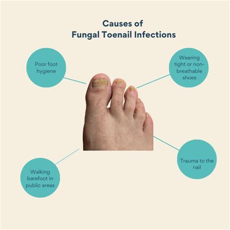 Learn all about fungal toenail infections