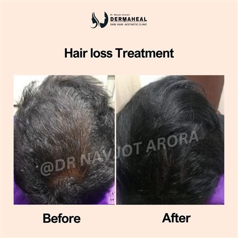 Hair loss treatment in Dwarka Delhi || Dermaheal Best Dermatologist in ...