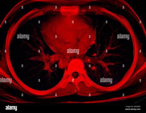 Image result for Poumon Normal Scanner