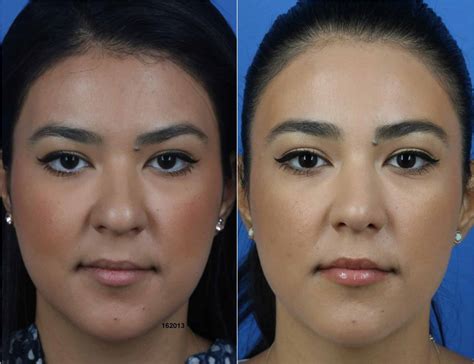 Buccal Fat Removal in New York City - Dr. Philip Miller