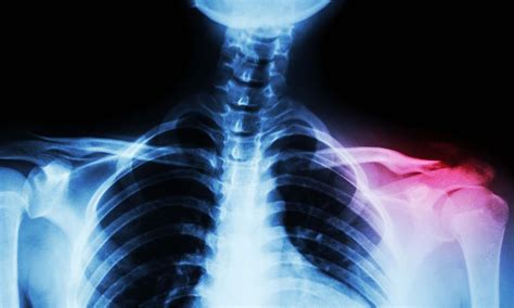 Intrathoracic Extension of a Giant Cell Tumour of the Medial End of ...