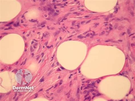 Image result for Dermatofibrosarcoma Protuberans