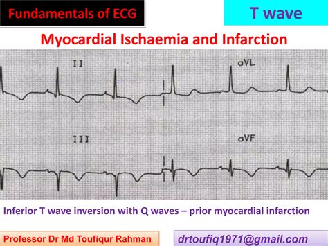 Approach to a patient with T wave abnormality in ECG | PPSX