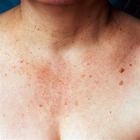 Sun damaged skin | Spot Check Clinic