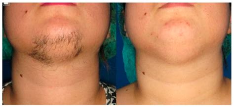 Laser Hair Removal Before And After Pcos at Austin George blog