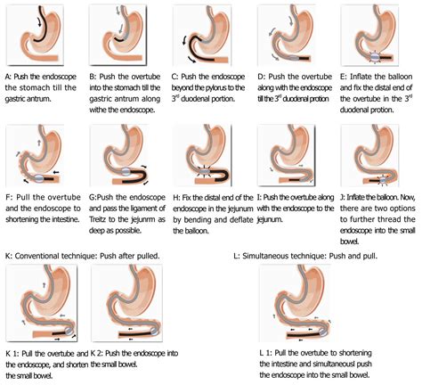 Capsule Endoscopy Vs Colonoscopy at Michael Blackwell blog
