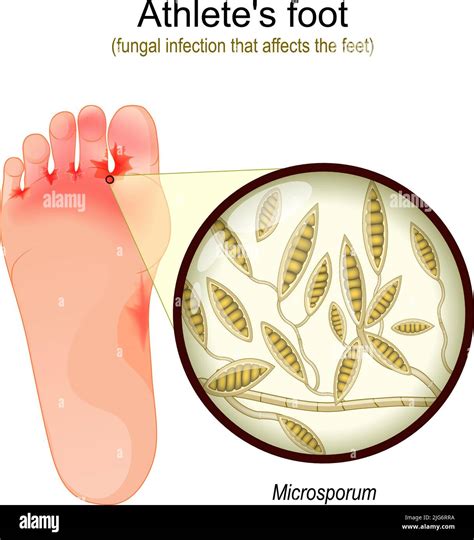 Athlete's foot. fungal infection that affects the feet. Close-up of yeast that causes infection ...
