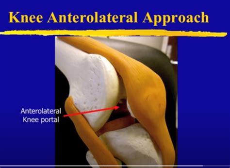 Image result for Ankle Anterolateral Approach Injection