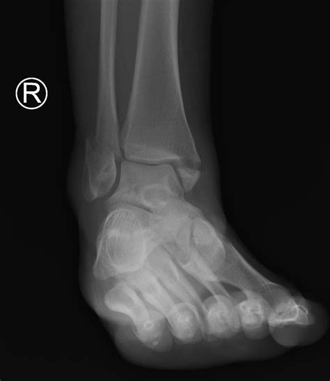Ankle x-rays – Don