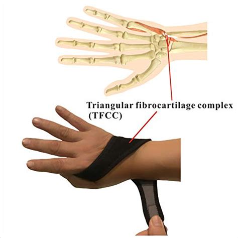 IRUFA,WR-OS-17,Breathable Neoprene Wrist Brace, for TFCC Tear- Triangular Fibrocartilage Complex ...