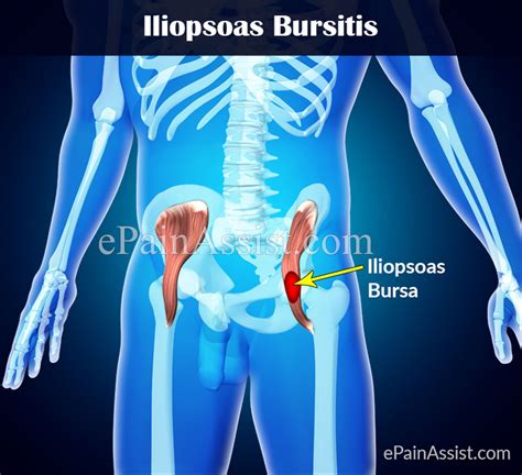Iliopsoas Bursitis or Iliopectineal Bursitis|Causes|Symptoms|Treatment|Exercises|Diagnosis