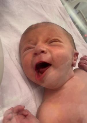 Congenital asymmetric crying face syndrome: a case of two newborns ...