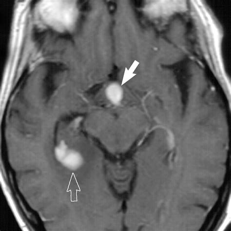 Anatomic and Pathologic Spectrum of Pituitary Infundibulum Lesions | AJR