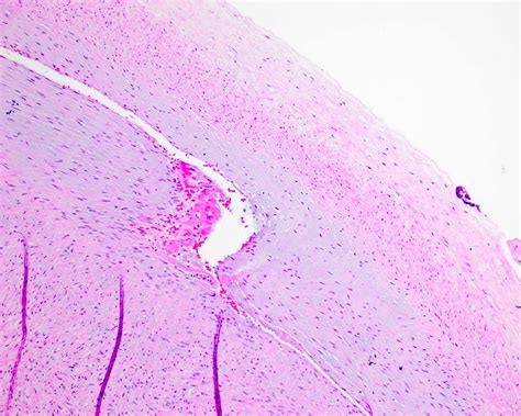 Pathology Outlines - Intrauterine fetal demise