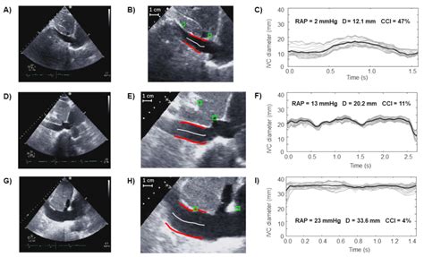 Non-Invasive Estimation of Right Atrial Pressure Using a Semi-Automated ...