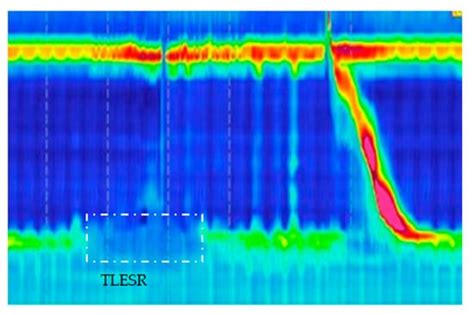 Utilizing Esophageal Motility Tests in Diagnosing and Evaluating ...