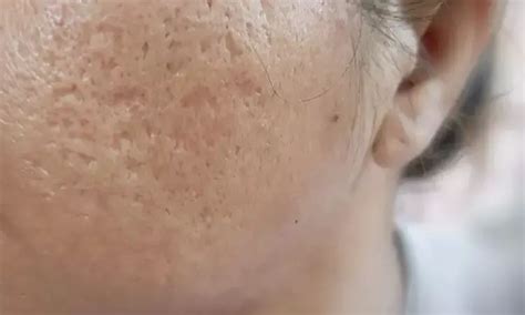 American Academy of Dermatology releases new guidelines of care for ...