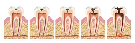 What dental treatment is needed