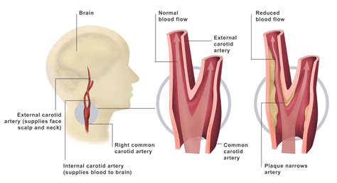 Left Common Carotid Artery