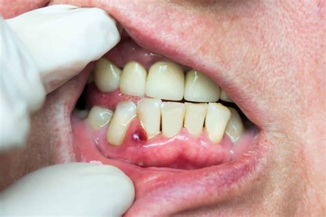 Infection In Gums Tooth at Anna Fermin blog