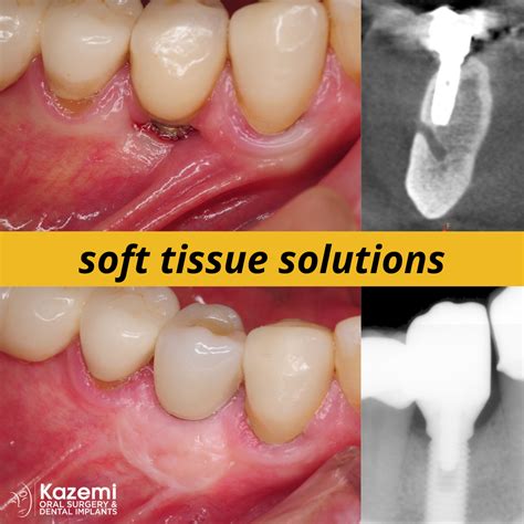 Treatment of Gum Recession Around Dental Implants with Soft Tissue Grafting | Treatment of Gum ...