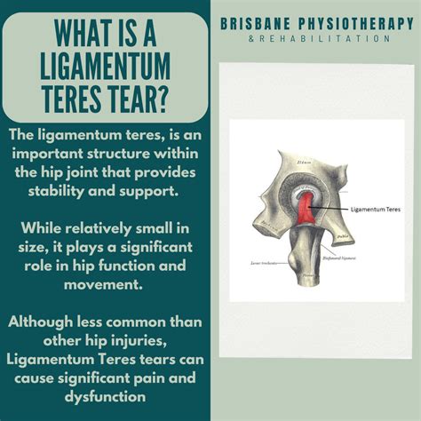 Ligamentum Teres Tears - Brisbane Physiotherapy & Podiatry